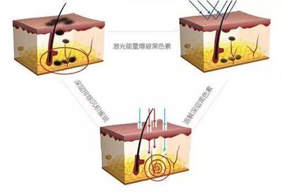 激光祛痣原理