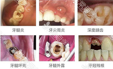 牙神经外露怎么治疗