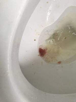 孕吐吐血丝是怎么回事