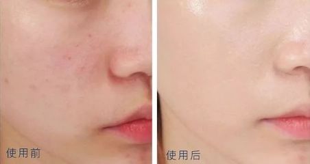 脸上的痘痘几个月都不消