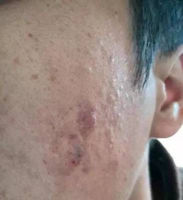 脸上好多痘印痘痘可以用维e吗