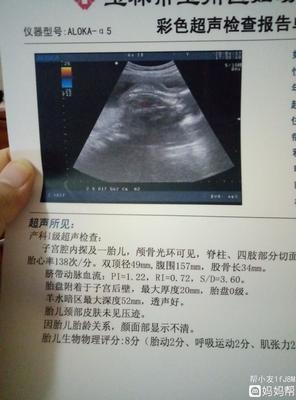 二十周的胎儿有多大