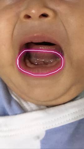 宝宝舌头底下正常图片