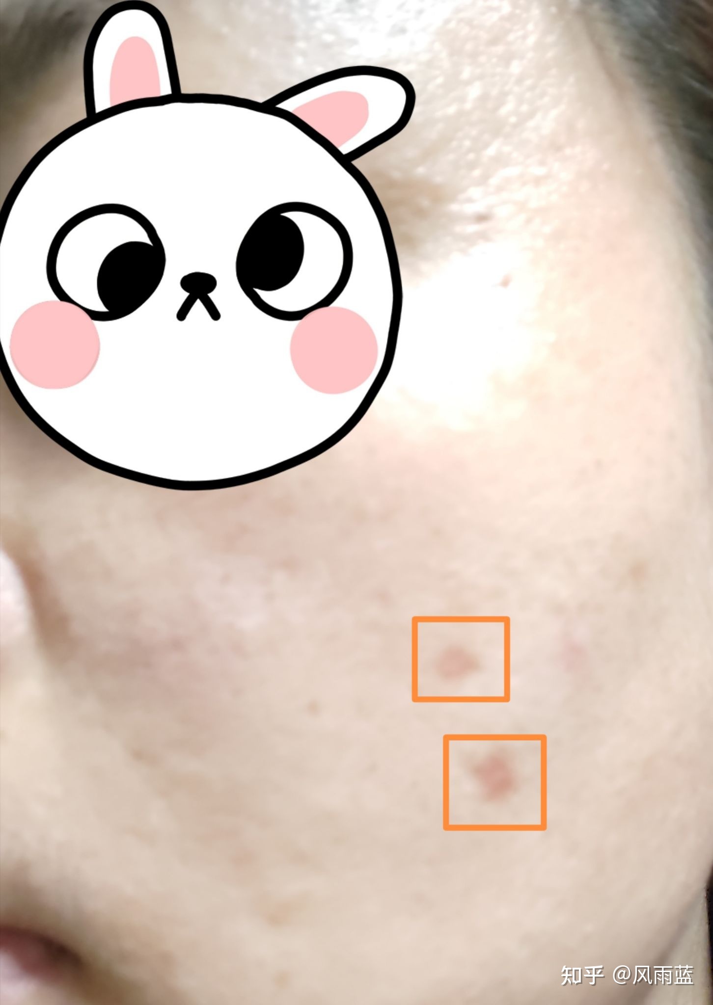 点痣以后怎么快速恢复