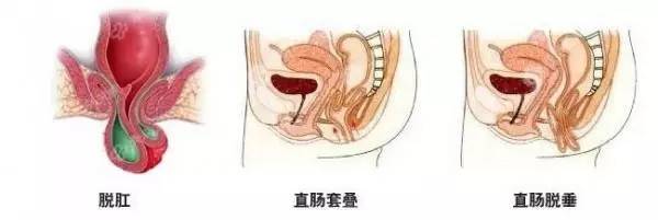 肠套叠是怎么回事