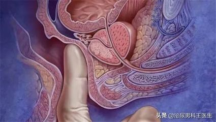 肠息肉是怎么回事