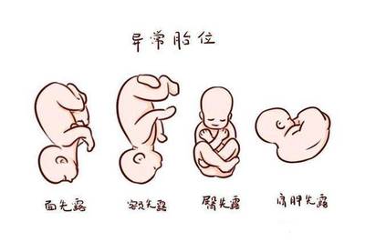 胎儿一直不入盆怎么办