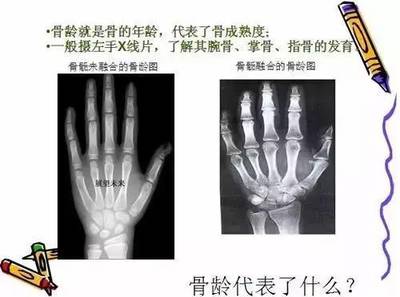 骨龄鉴定年龄准确吗