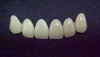 烤瓷牙什么意思