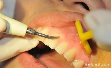 怀孕5个月牙龈肿痛怎么办