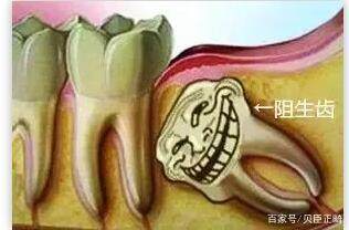 蛀牙拔了一定要种牙吗