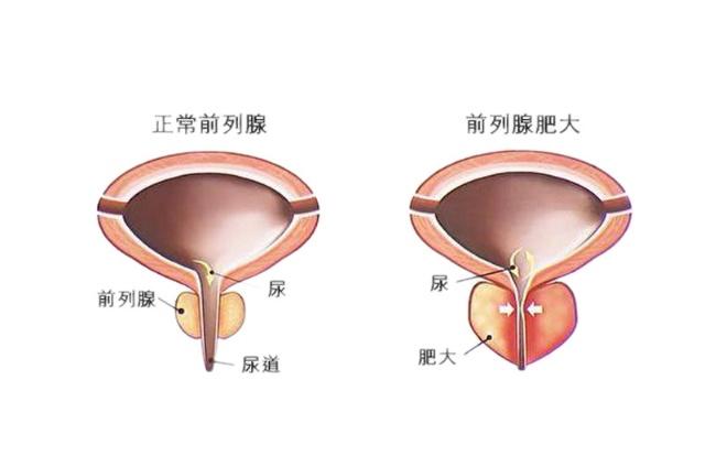 看前列腺肥大要多少钱