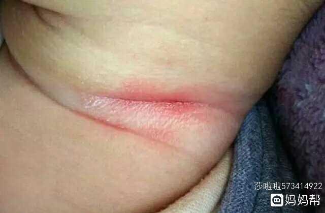 宝宝淹脖子