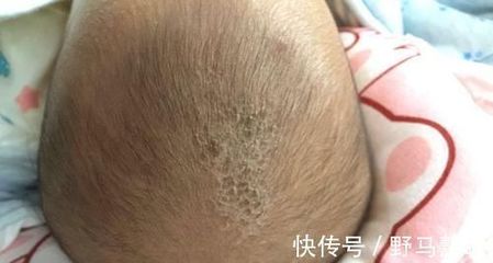 宝宝头皮上有结痂是怎么回事