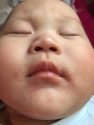 宝宝下巴长痘痘是什么原因