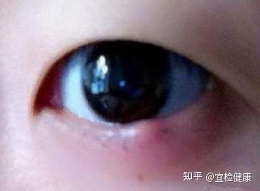 长针眼怎么治疗