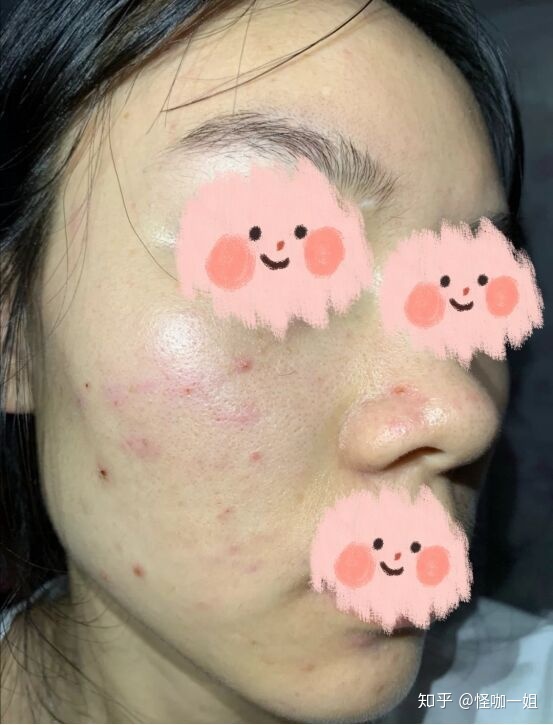 如何把痘痘皮肤养好