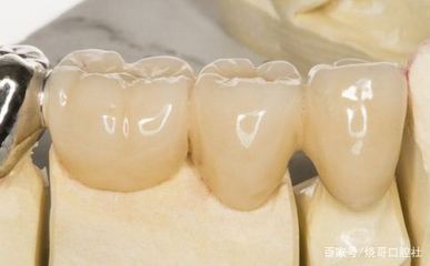 镶的牙齿掉了粘回去多少钱 镶的假牙掉了怎么办