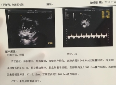 胎儿心跳是什么声音
