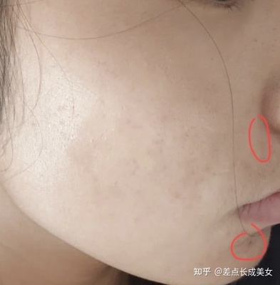 怎样让痘痘消掉