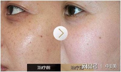 怎么治疗雀斑