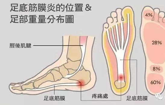 足底筋膜炎怎么治疗