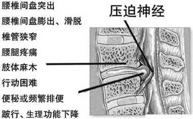 腰间盘突出压迫神经怎么治疗