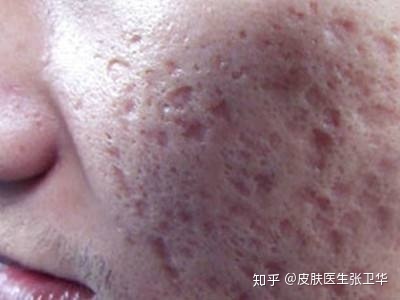 满脸都长痘痘怎么回事