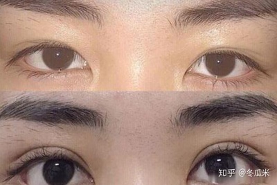 割双眼皮6年后眼皮下垂