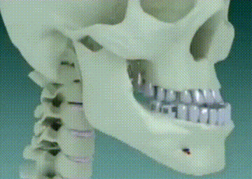 牙齿正颌正畸报销吗