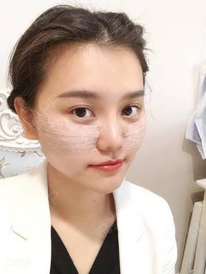 瘦脸针几天有感觉