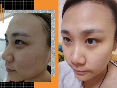 为什么痘坑不长痘痘