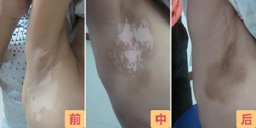 腋下有白斑是怎么回事