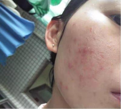 3个痘痘是什么