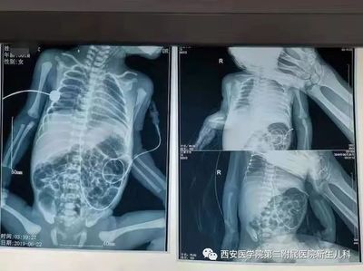 心脏影增大是怎么回事