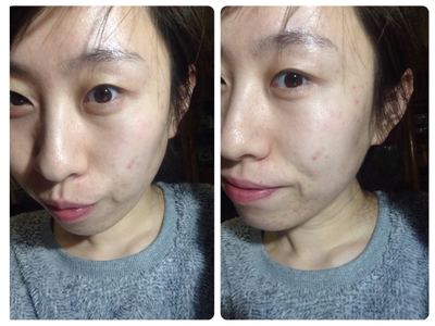 痘痘挤破后怎么不留疤