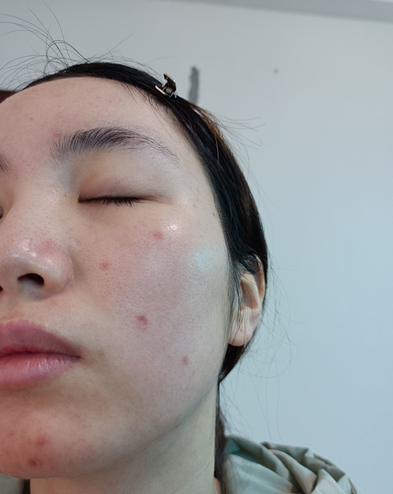 可以祛痣吗