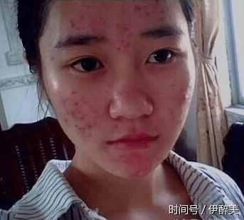 女孩脸上总是长痘痘怎么办