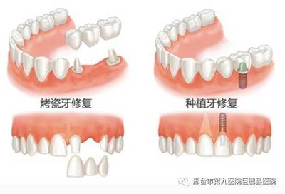 什么情况下做烤瓷牙