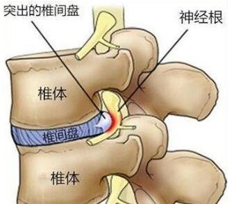 腰间盘突出压迫神经怎么治疗