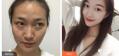 激光点痣多久可以化妆