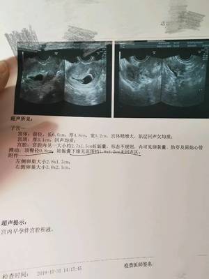 怀孕20天出血是怎么回事