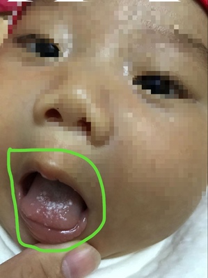 舌头右侧疼是怎么回事