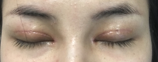 双眼皮切口处发红