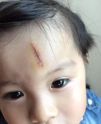 小孩烫伤疤痕怎么办