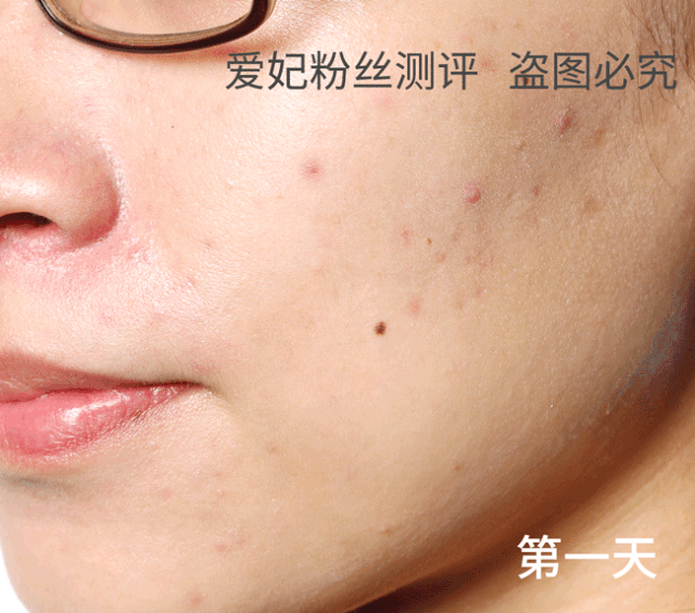 痘好了变成白色痘印
