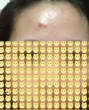 痘痘挤了几天能好