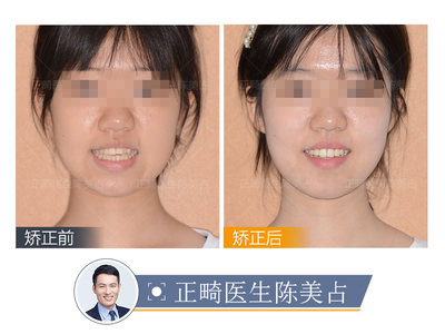 深覆合会怎样影响脸型