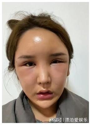 双眼皮刀疤多久能恢复