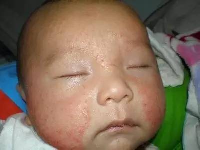 湿疹能喝奶粉吗